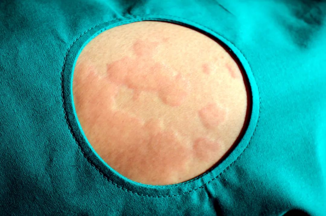 *麻疹荨**反复发作，瘙痒难忍？试试这种中医特色疗法