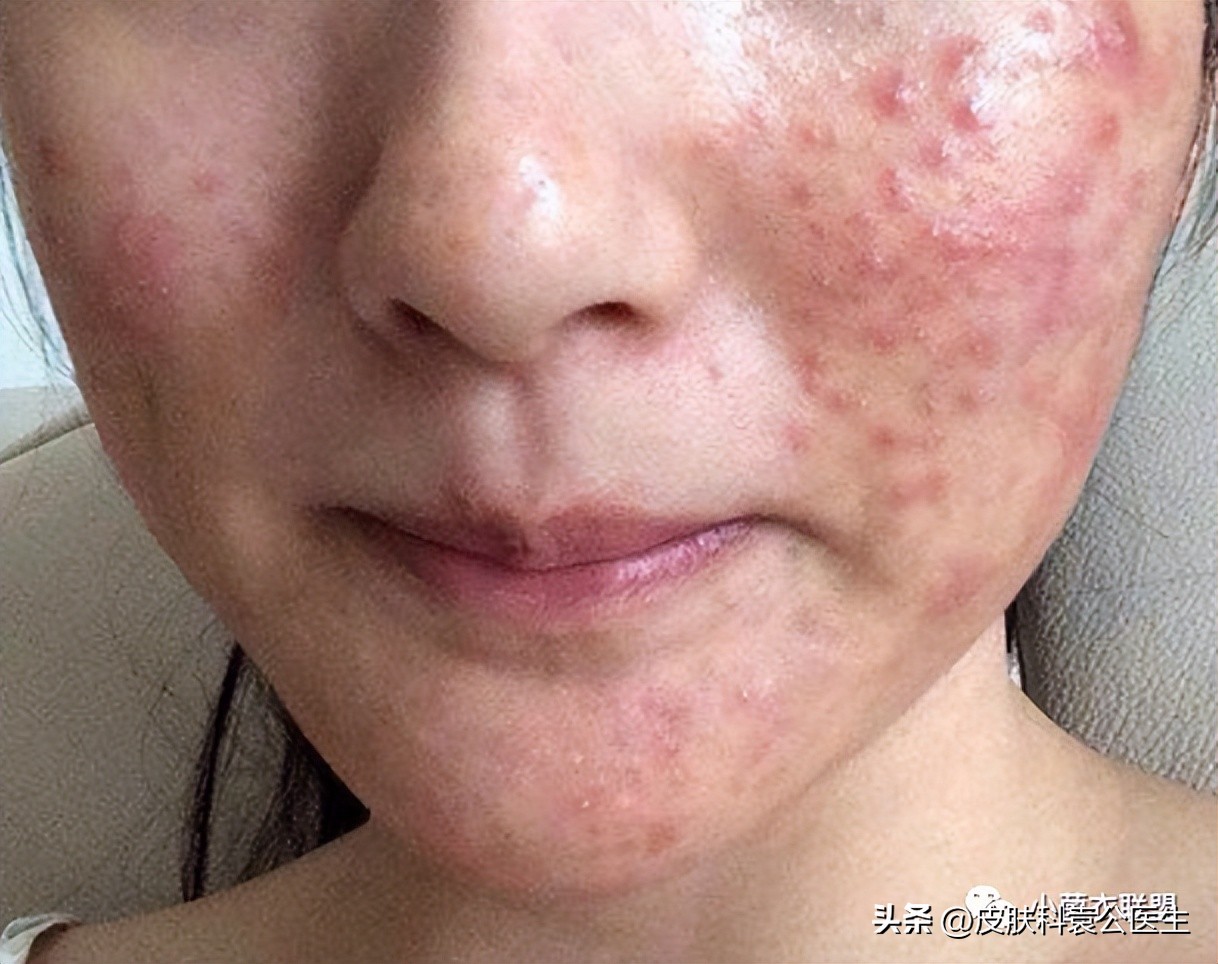 肾病发物忌口的食物一览表,得了皮肤病是否要忌口