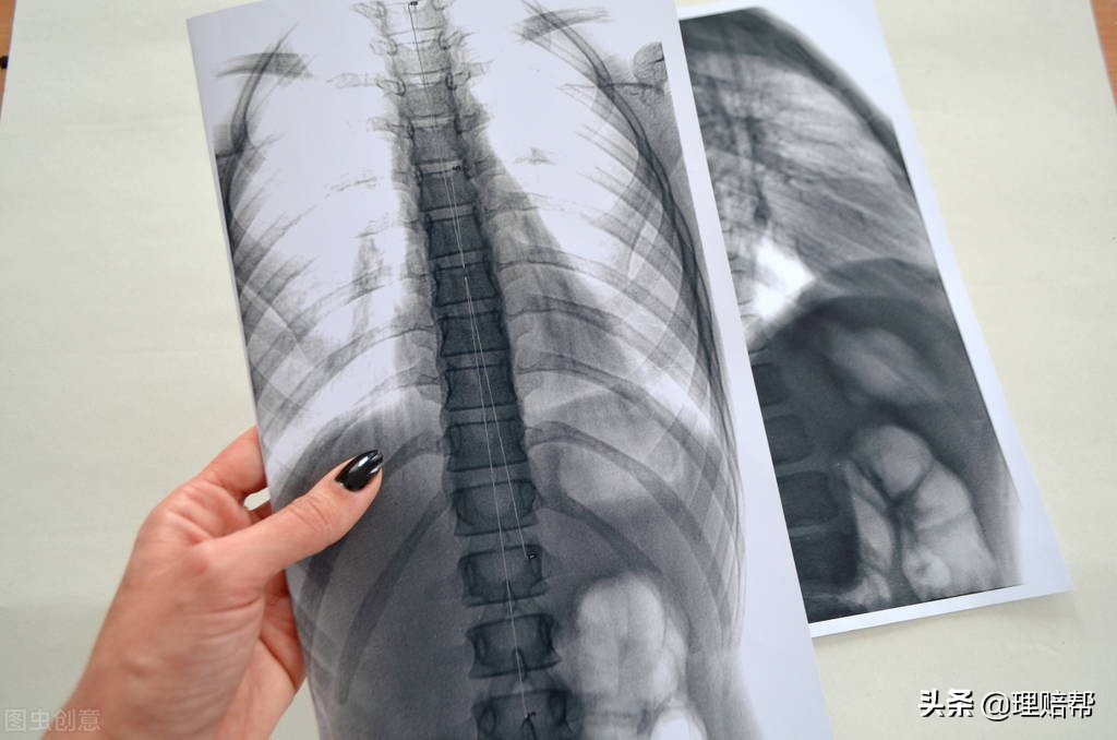 脊柱侧弯学平险能报销吗,儿童脊柱侧弯有商业保险报销吗