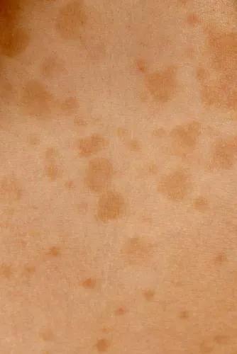 阳康后背上长痘,阳康后后背长疹子