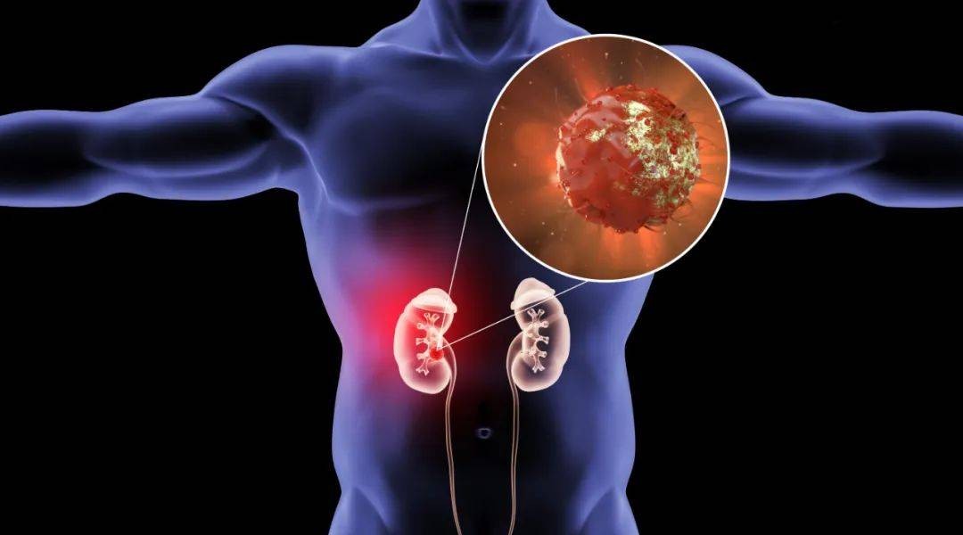 高尿酸是吃出来的少吃六种食物,高尿酸最怕六种食物