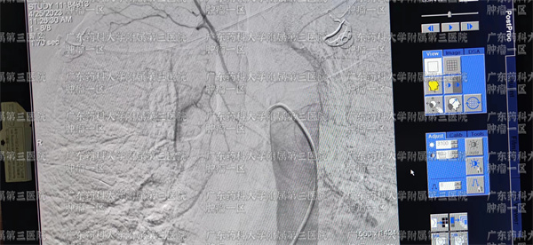 广药三院肿瘤介入,中山大学附属肿瘤医院治疗食道癌