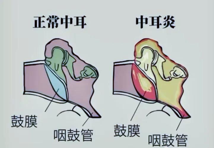 宝宝半夜突发耳痛警惕急性中耳炎,小孩半夜说耳朵疼是不是吓到了