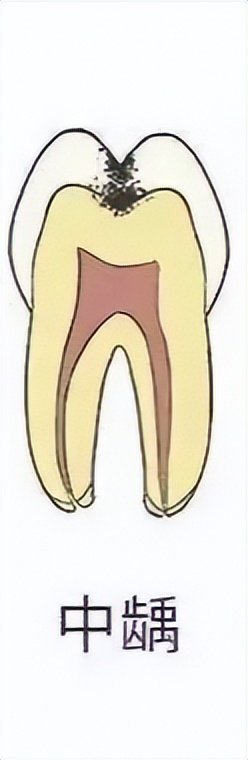 早期龋齿和中期龋齿的区别,科普口腔龋齿图片
