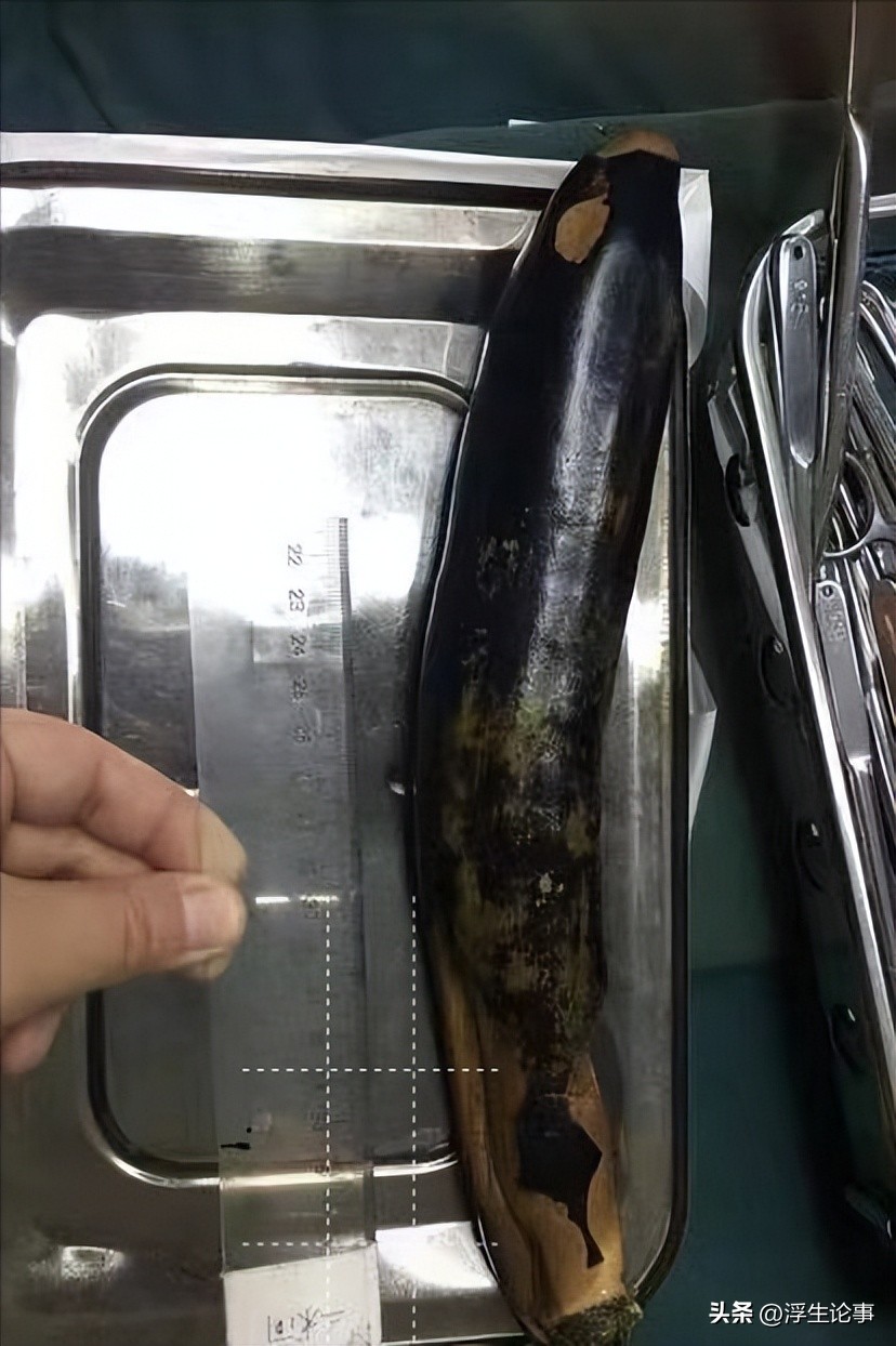 成人直肠内取出60厘米异物,小伙直肠内取出20厘米异物