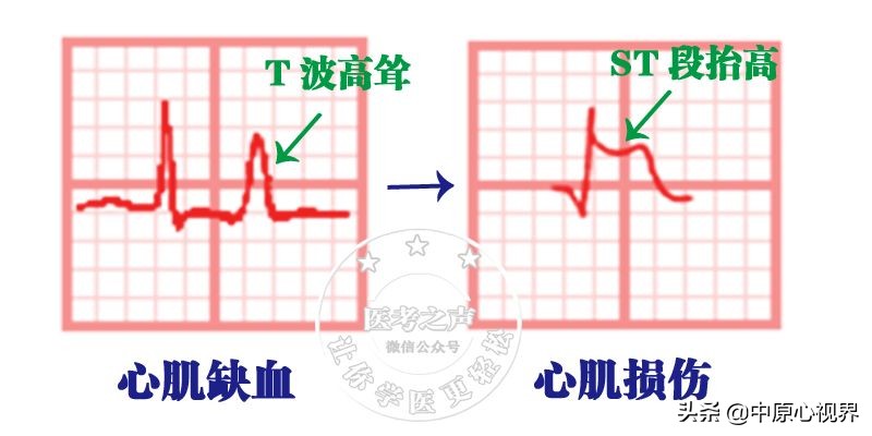 护考几种常见的心电图,常见的心电图图形分析