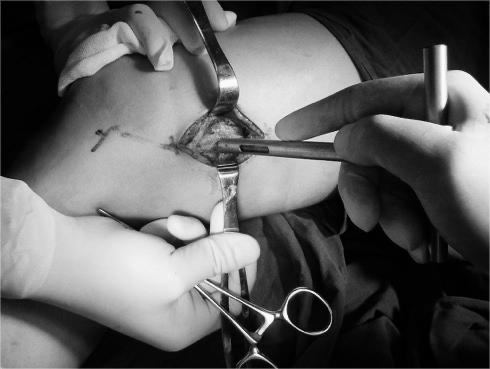 恶性软组织肿瘤有多严重,恶性神经鞘瘤就是软组织肉瘤吗