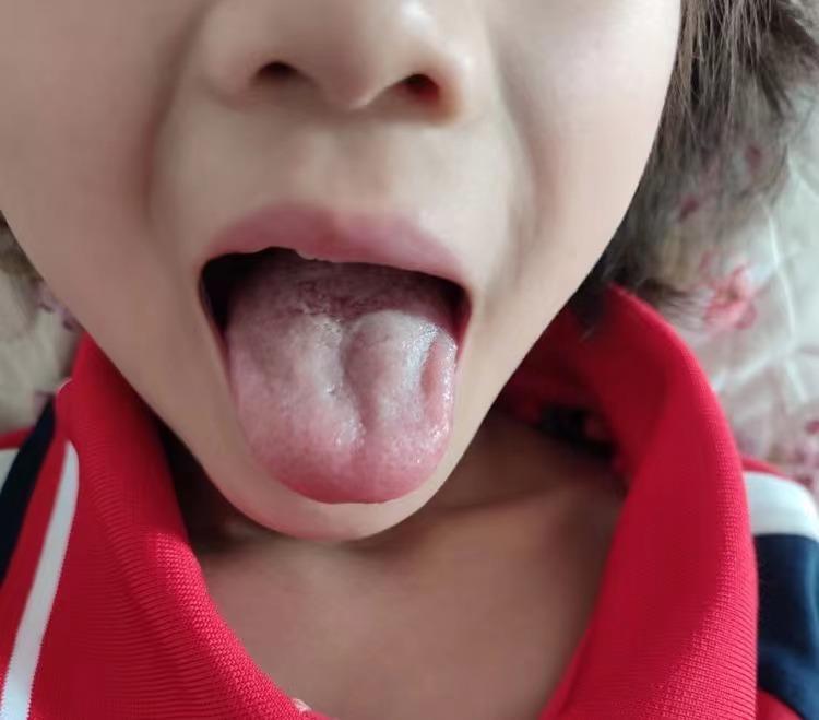 孩子腺样体肥大鼻塞调理脾胃的药,腺样体肥大14岁中医调理