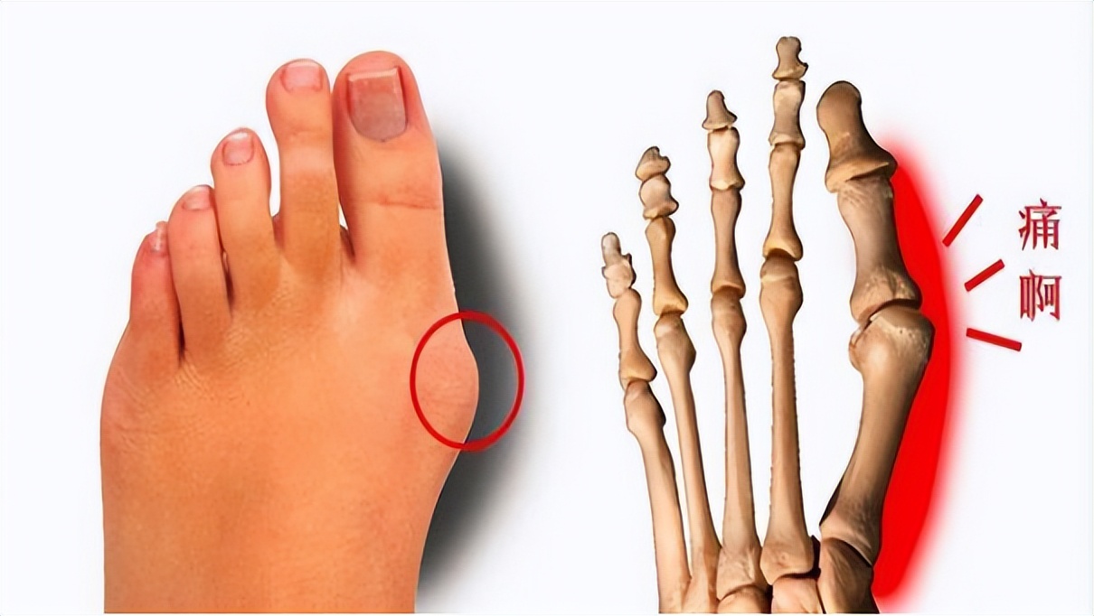 大拇脚趾往里歪怎么矫正,严重拇外翻脚趾畸形怎么办