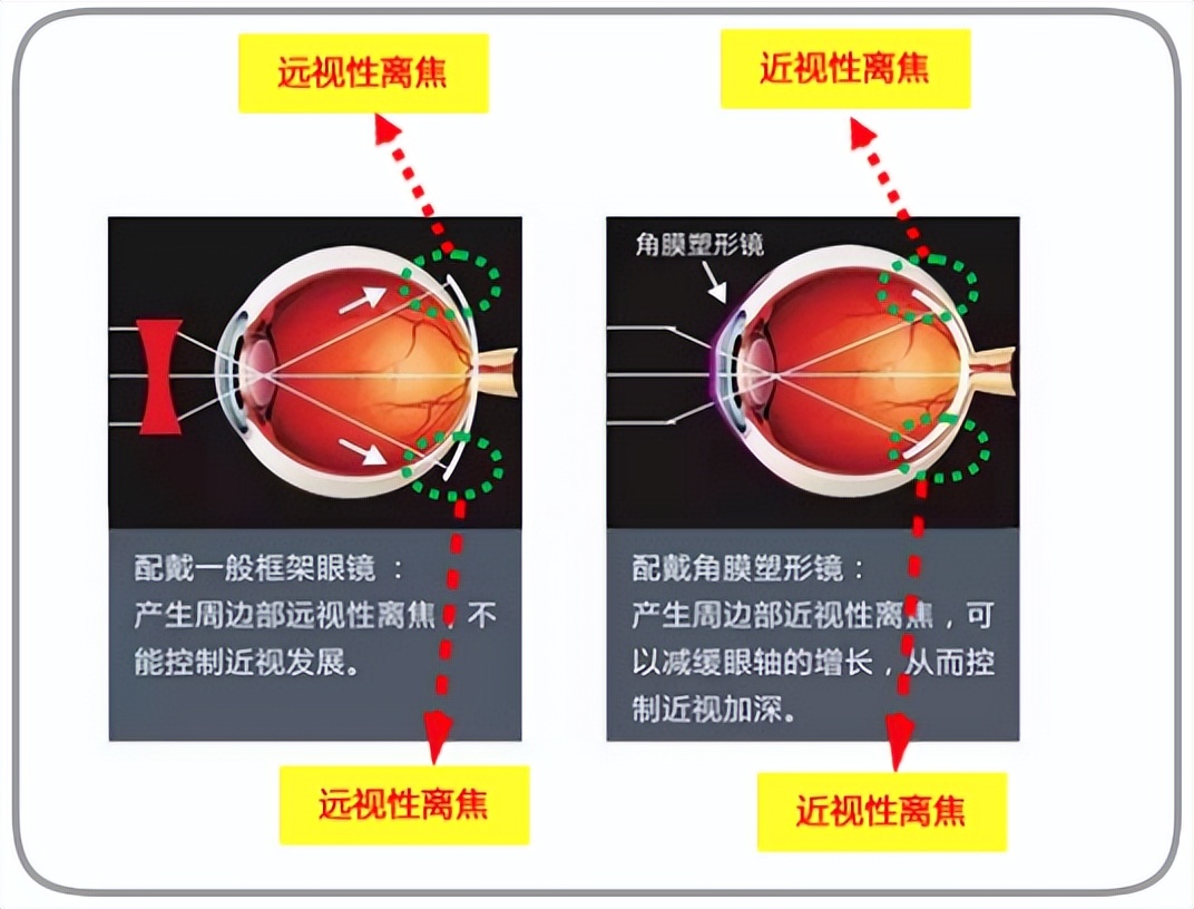 角膜塑形镜停戴几天怎么处理,角膜塑形镜容易出现的问题图片