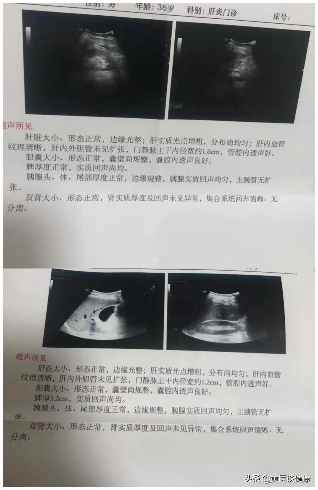 乙肝小三阳门静脉增宽16能活多久,抗病毒1年反而肝纤维化严重了