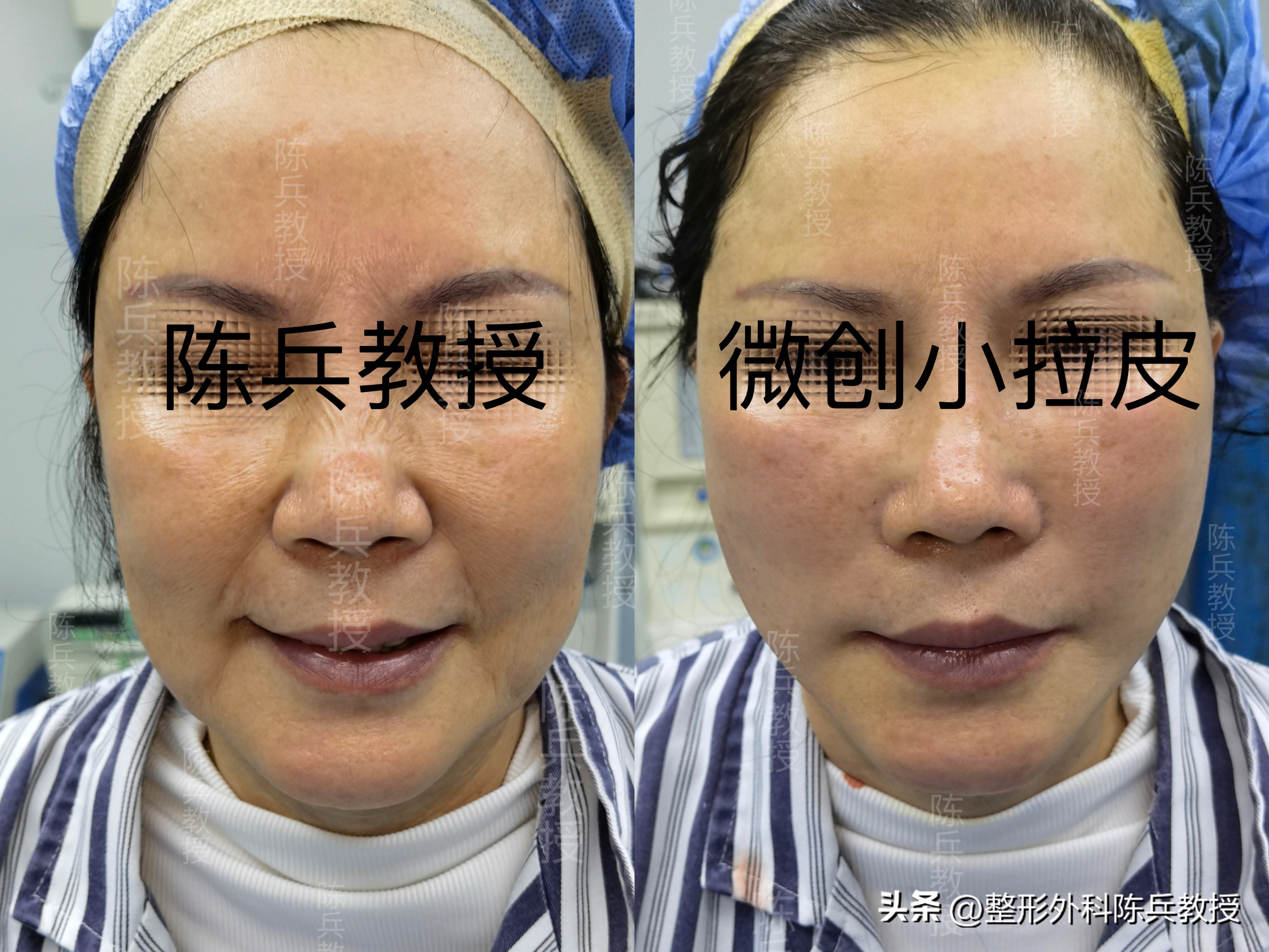 大拉皮和小拉皮哪个效果好,大拉皮跟小拉皮的区别是什么