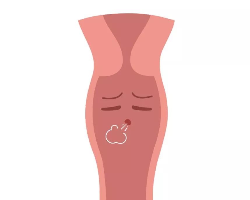 阴道炎反复，小心阴道口闭合不全