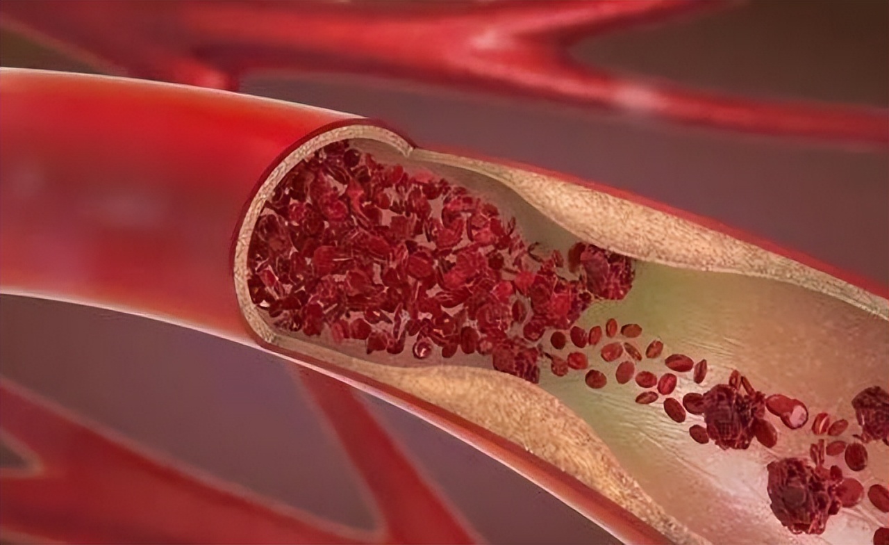 吃深海鱼油对血管狭窄有帮助吗,醋红酒鱼油是否能软化血管