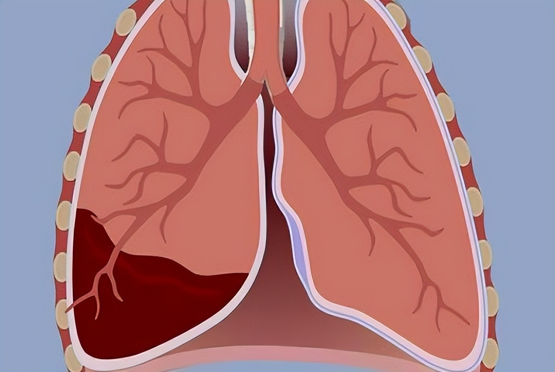 胸腔积液是属于重大疾病吗,胸腔积液一般是由什么原因导致的