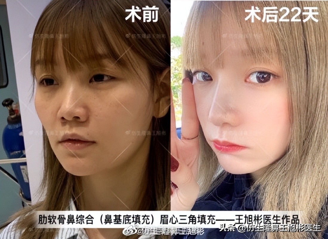 鼻翼缩小可以改善鼻翼缘后缩吗,鼻翼肥大如何正确改善