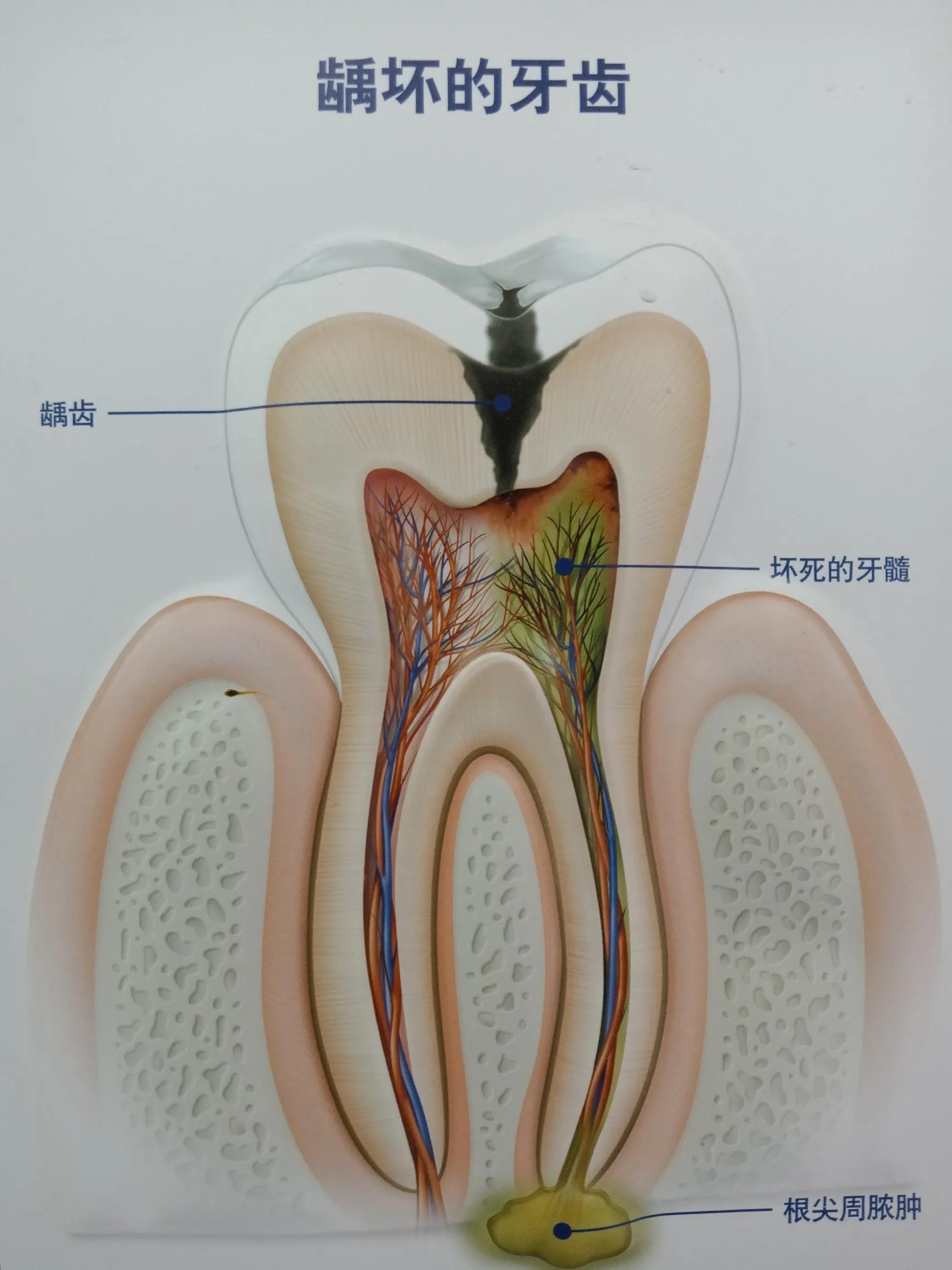 牙齿根部有黑黑的硬东西,牙齿有个洞黑黑的