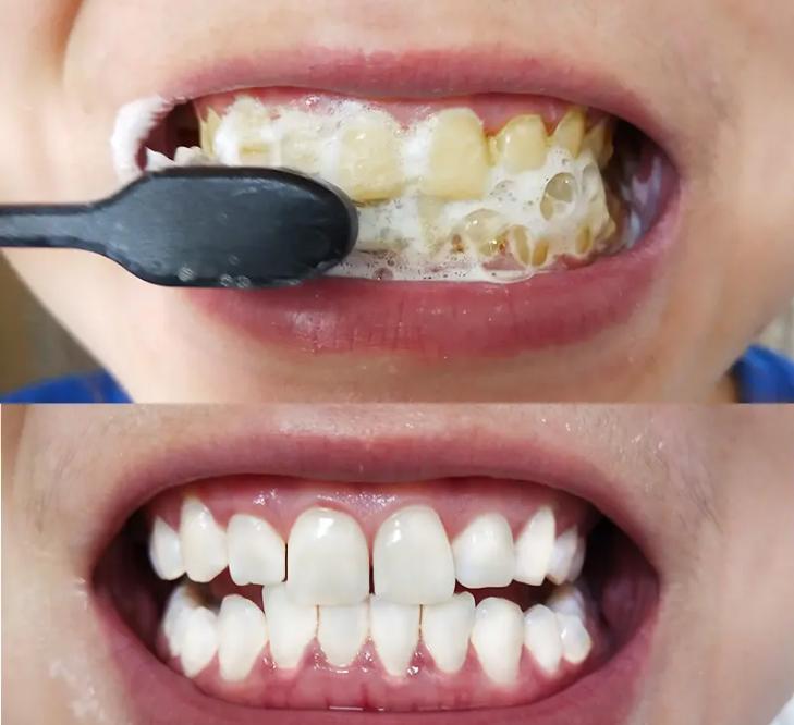 最有效去牙黄牙渍的产品,白牙神器去牙渍