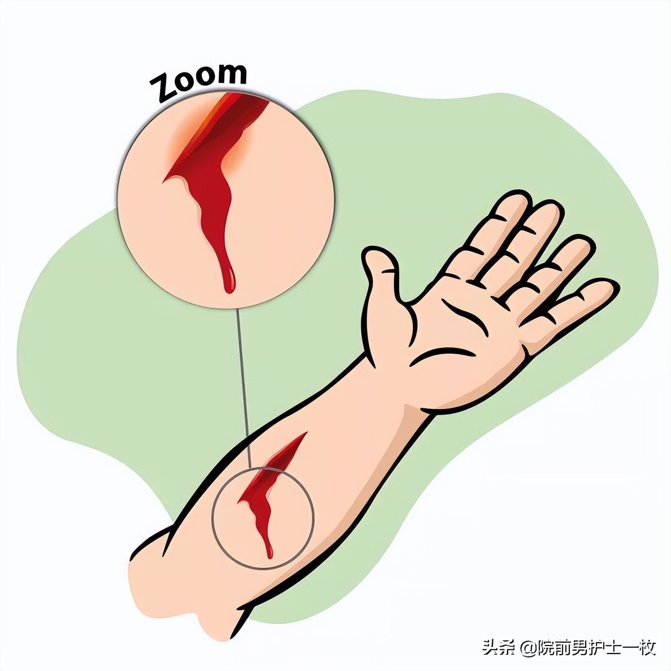 破伤风疾病的相关知识,破伤风的定义和处理方法
