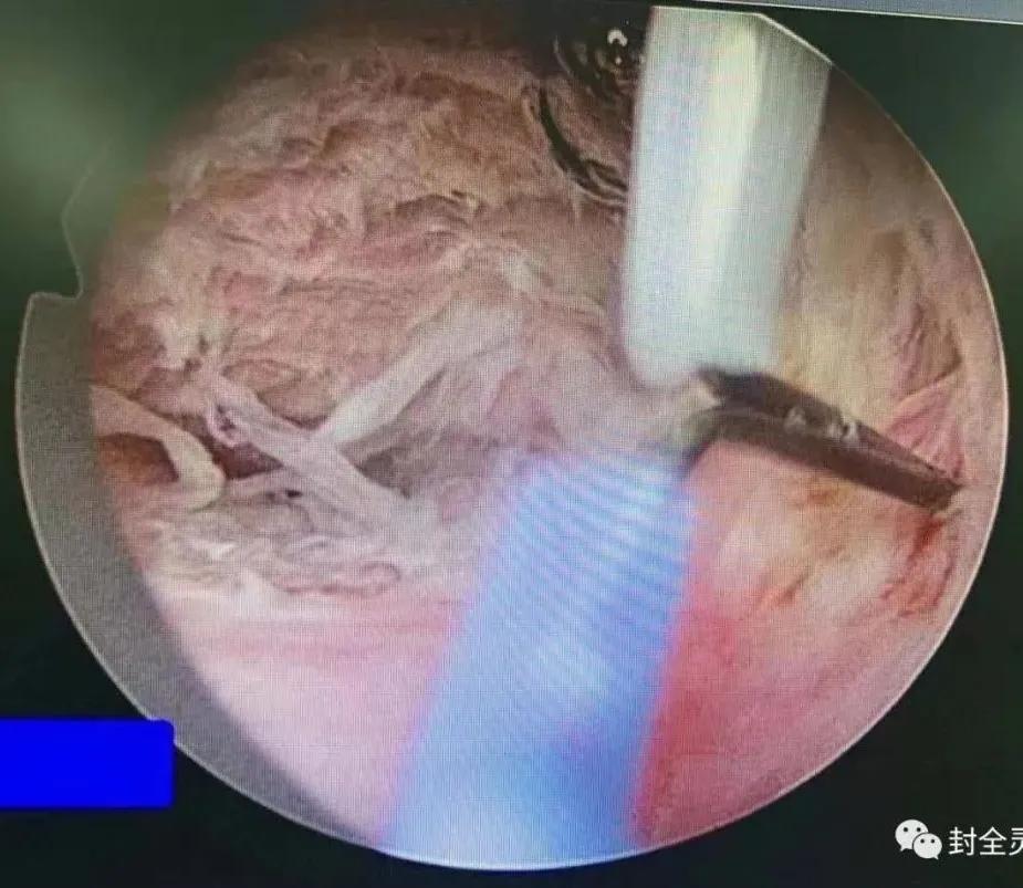 妇科专家教你认识宫腔镜,宫腔镜妇科主任