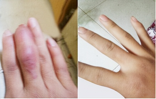 河北省中医院陈旧疤痕好修复吗,郑州第二中医院治疗疤痕怎么样