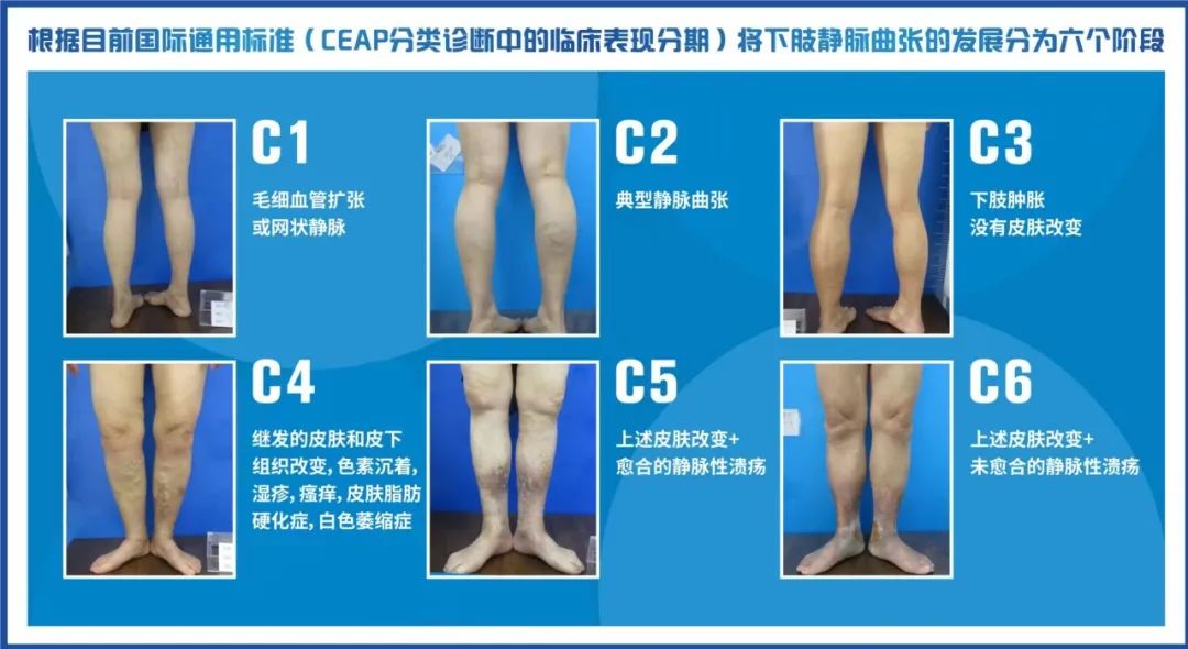 陕西省人民医院静脉曲张治疗方法,小腿静脉曲张真实病例逆转方法