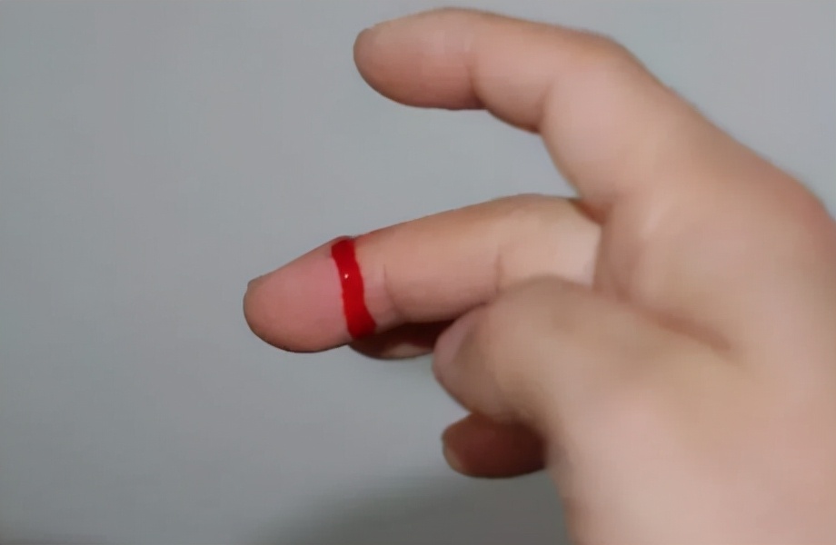 孩子磕碰怎么办,小孩子磕碰划伤擦什么药好