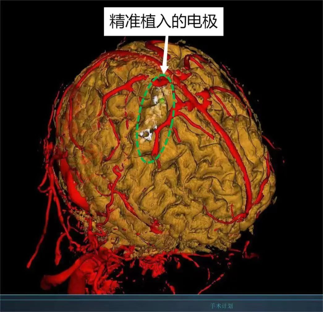 西安二附院重复经颅磁刺激,湘雅附二医院机器人手术