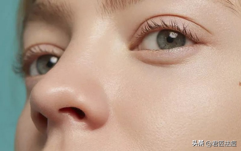 鼻子上长痘痘最快消除的方法,鼻子上长痘痘怎样根治