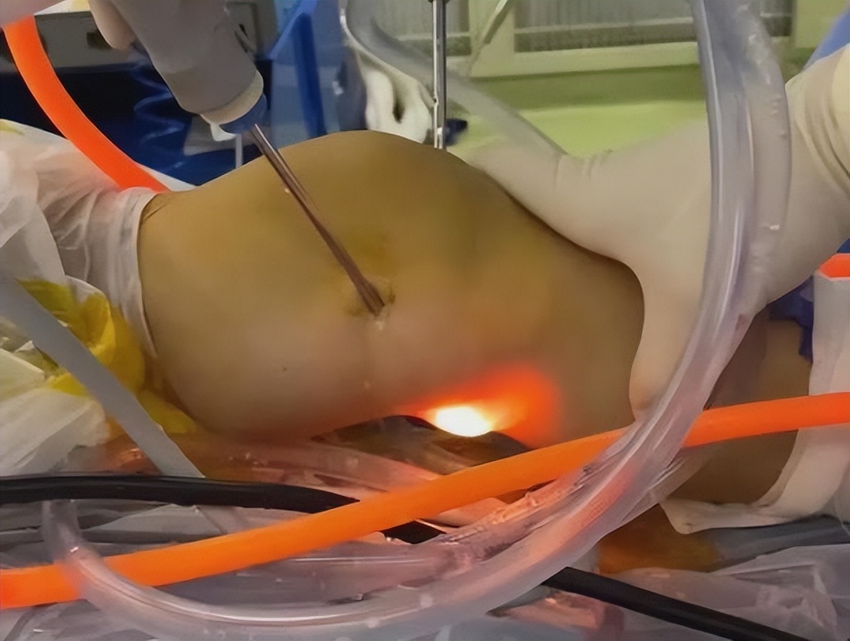 腿窝旁边起了一个鼓包是积液吗,腿左侧腘窝囊肿怎么治疗