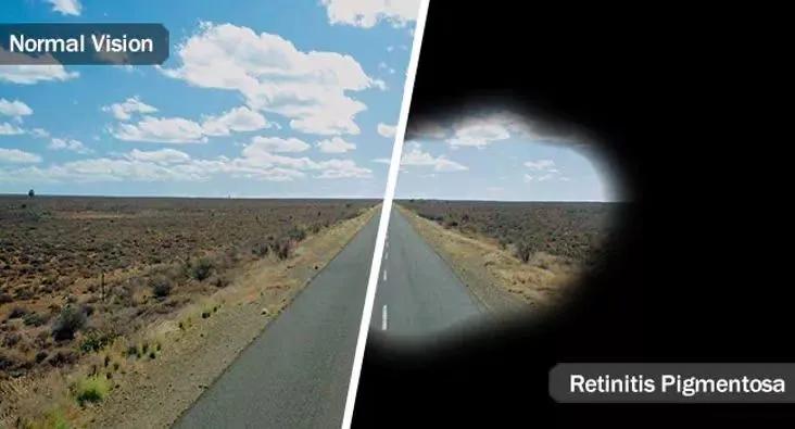 罕见眼病患者的绝望与挣扎,无法治愈的眼疾