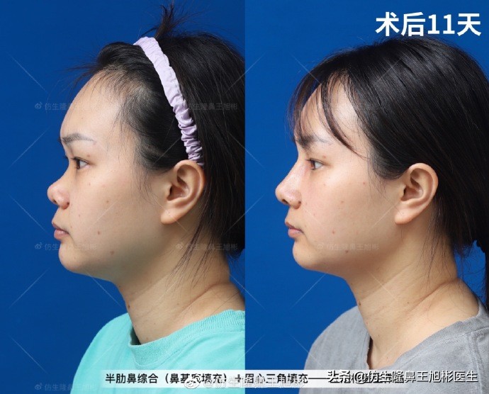 常见鼻部整形美容项目,整形鼻和自然鼻