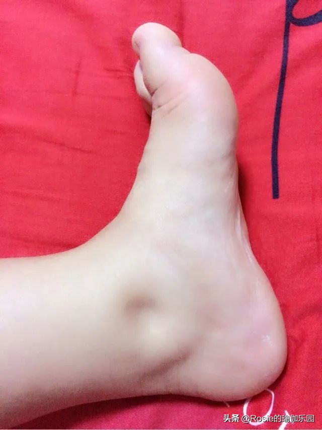 脚踝粗有办法瘦吗,脚踝很细大腿很粗怎么瘦