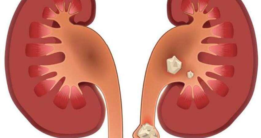 硬水喝多了有什么后果,硬水喝多了会结石吗