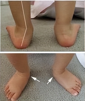 1岁宝宝不愿走路总是要爬怎么办,2岁宝宝一只脚扁平足怎么办