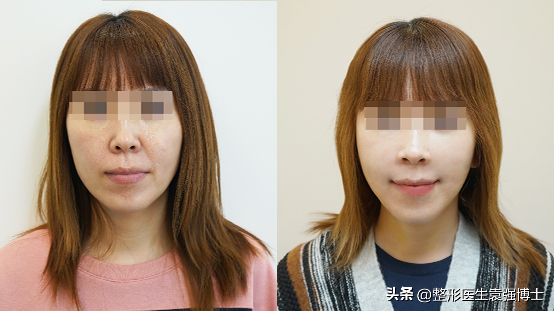 法令纹怎么解决一招搞定,法令纹难解决