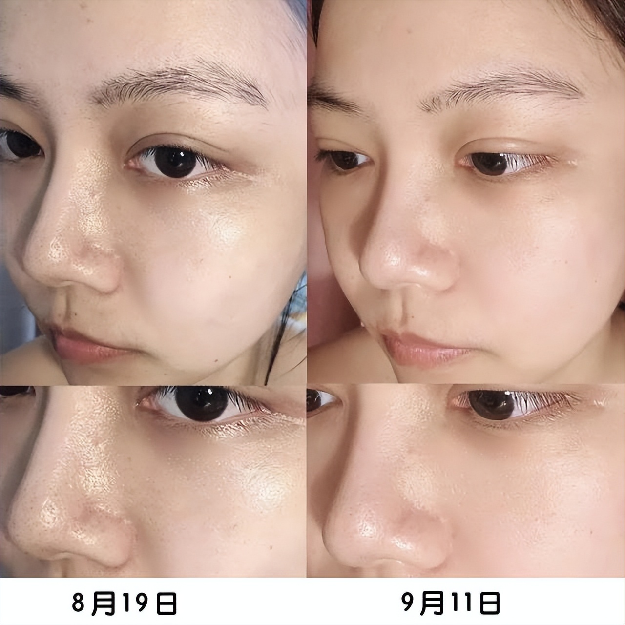 泰国美白针真实事件,女子连续打6年美白针