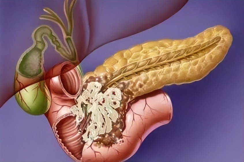 胰腺癌免疫治疗的研究进展,如何利用微生物扩增基因