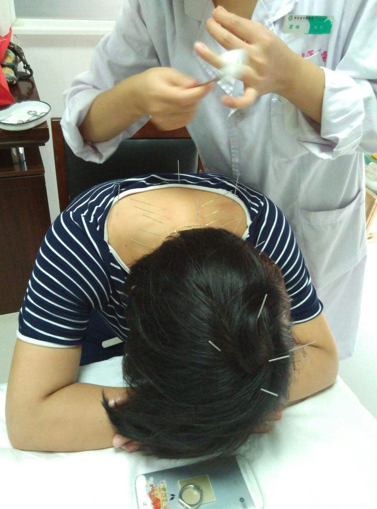 中医扎针治疗偏头痛,夹脊脉冲电针疗法