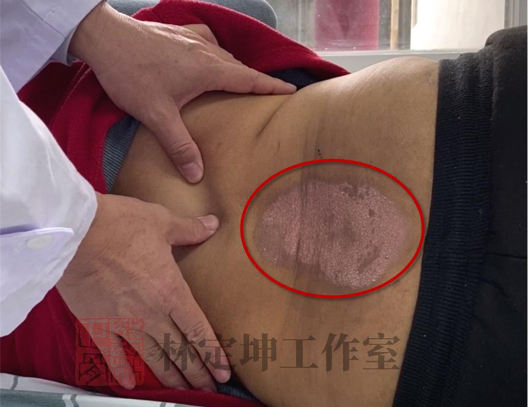 中医正骨腰椎疼痛,腰痛针灸和贴膏药哪个效果好