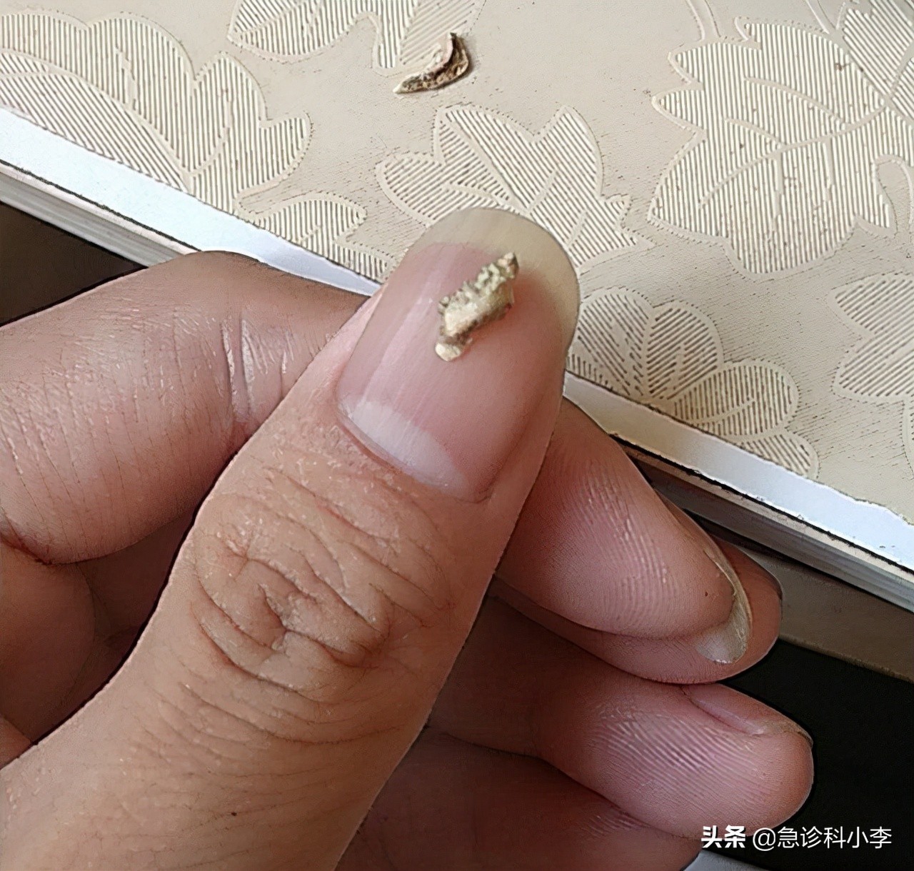 在牙缝里的牙结石要怎么去除,牙缝的牙结石怎么自己去除