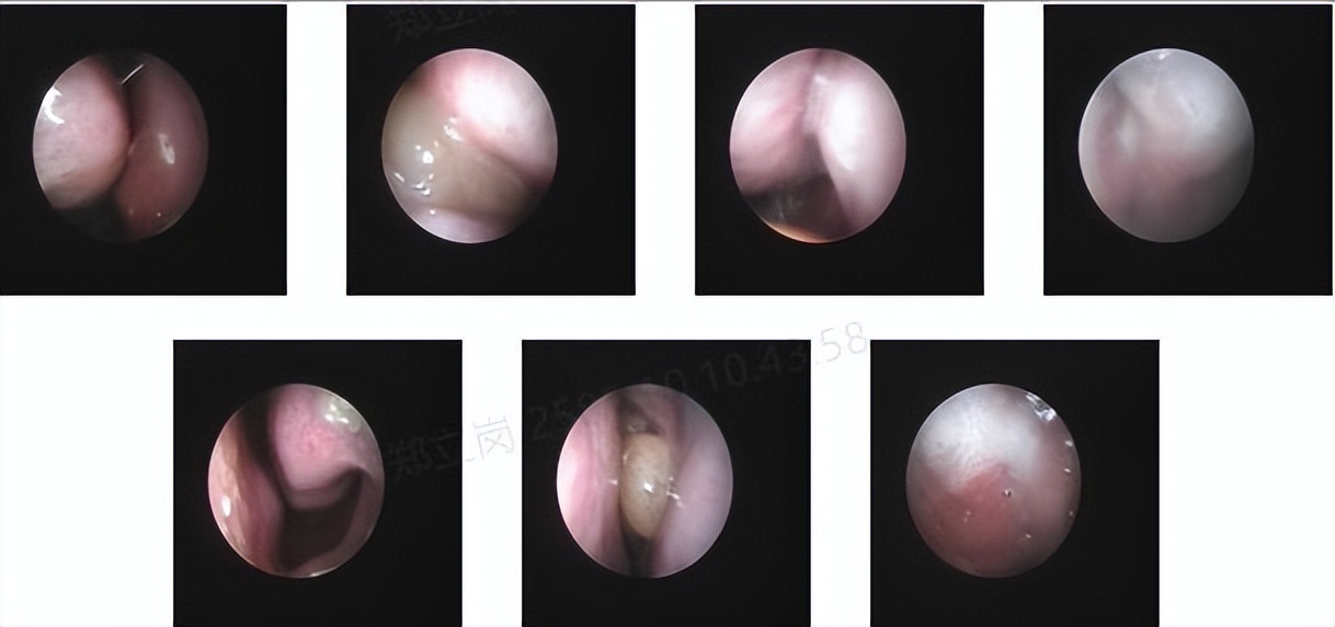 反复鼻塞,好不了,这次总算找到了原因