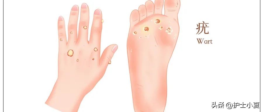 治疗hpv感染用干扰素注意事项,感染hpv后十大禁忌男性注意什么