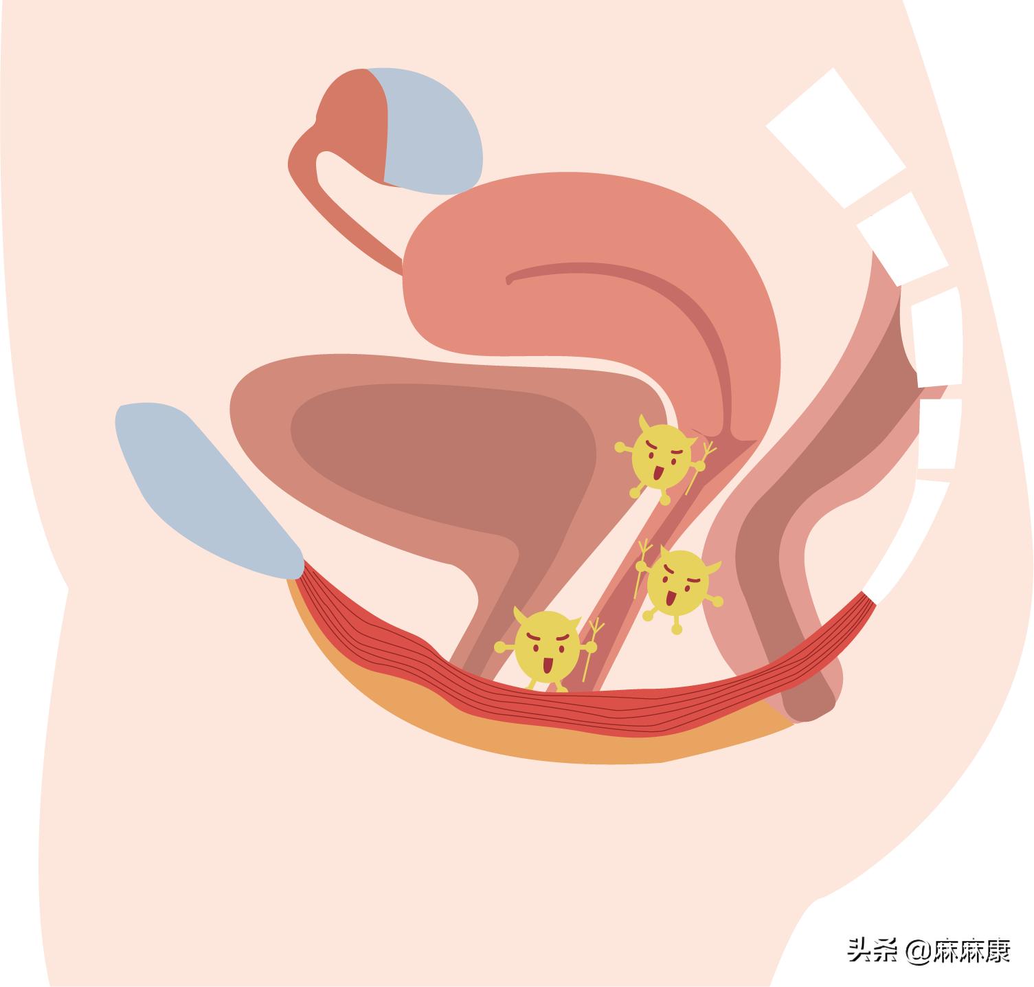 同房出血怎么办?这些措施很重要