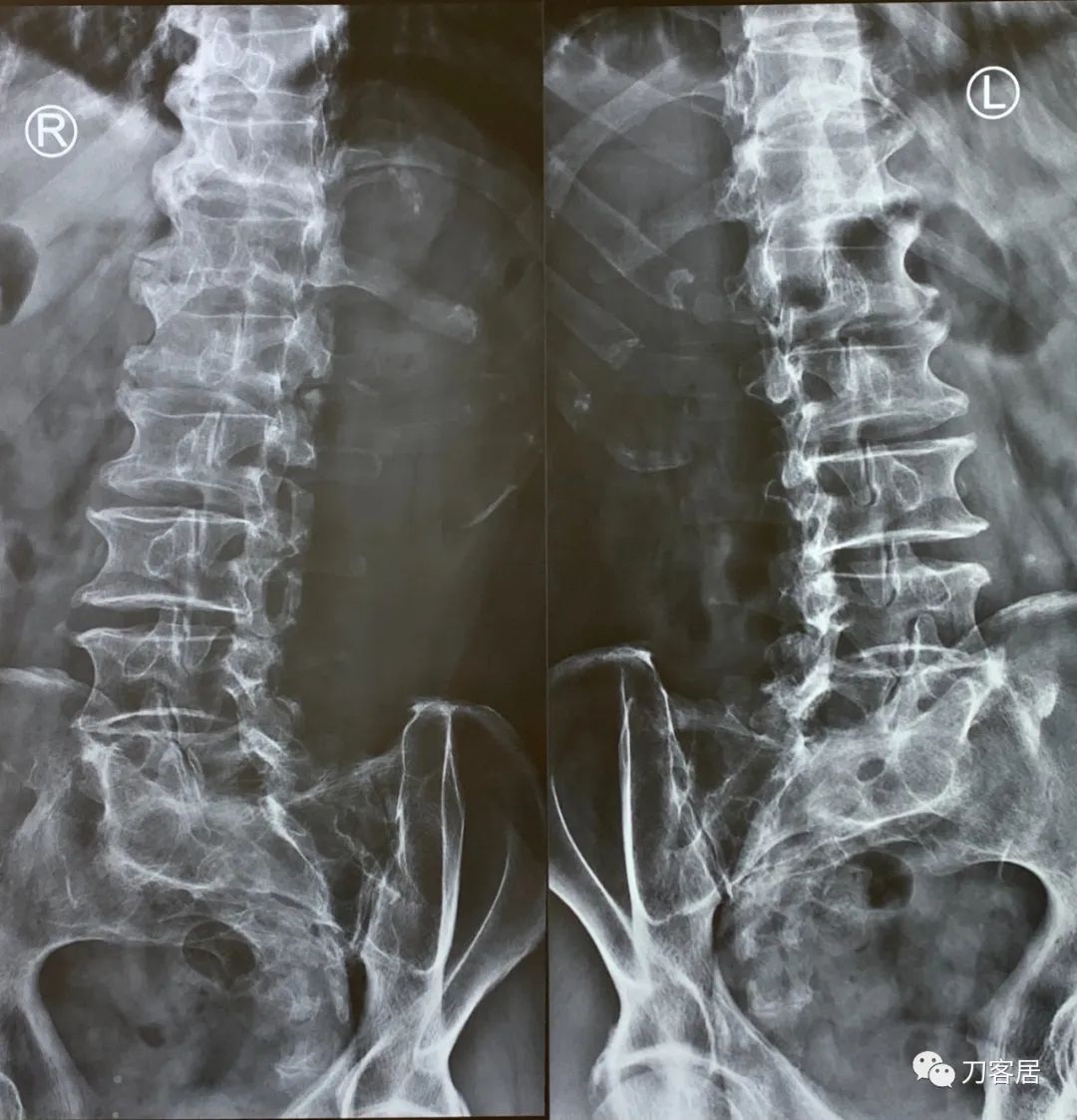 又是颈椎病，又是腰椎滑脱，又是骶管囊肿，多家医院就诊...