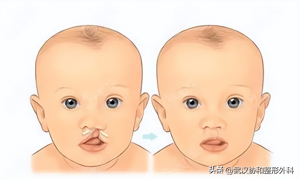 唇腭裂做一次手术就好了吗,唇腭裂一次性做完鼻子好吗