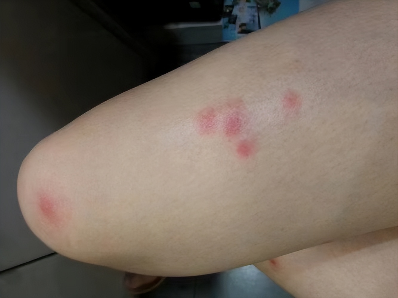 一到夏天，胳膊、腿就起大包，又红又肿还刺挠，这究竟是咋回事？