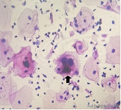 宫颈癌筛查TCT、HPV傻傻分不清，病理科为您来揭秘