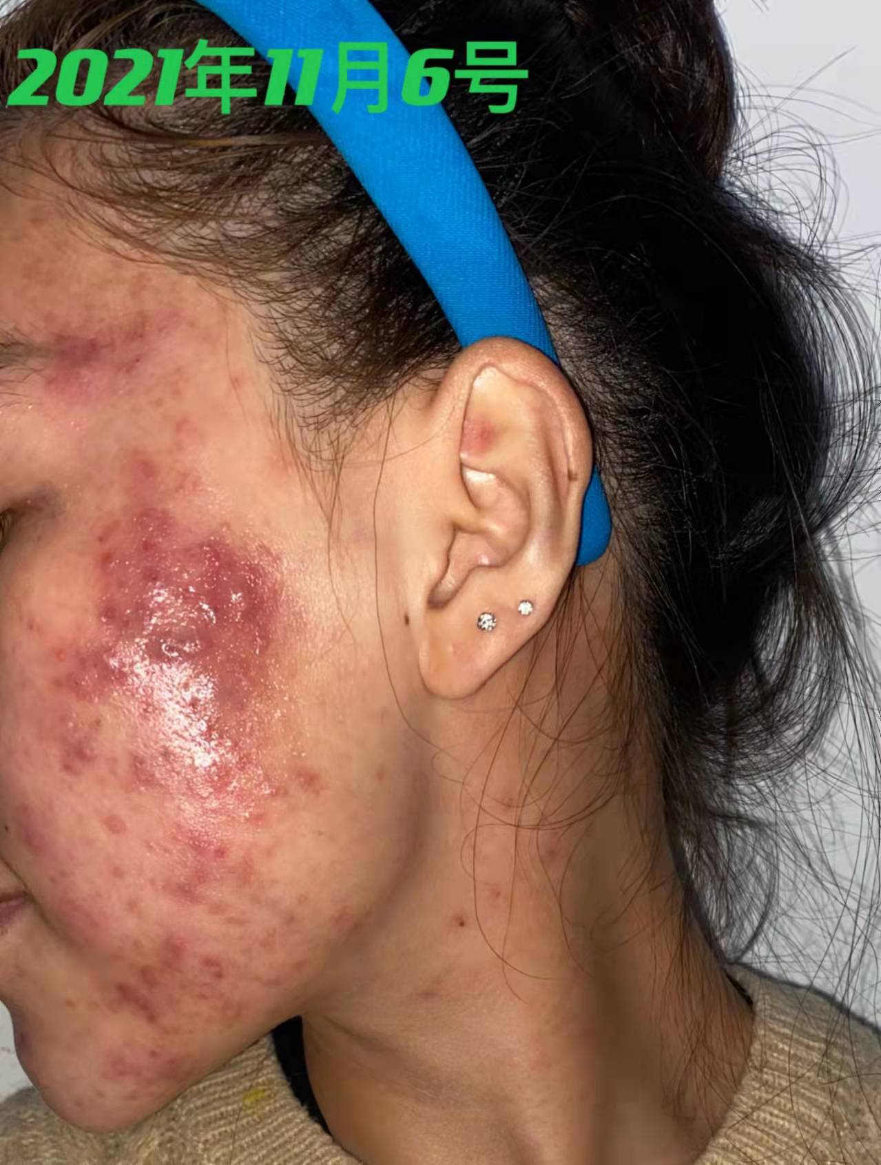 28岁女脸上反复长痘怎么办,28岁痘痘反复长是什么原因