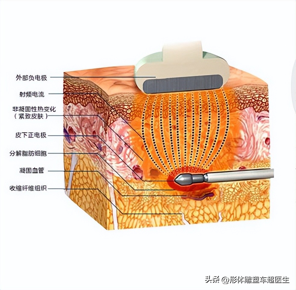 脸部激光溶脂后有疙瘩吗,脸部激光手术后皮肤松弛